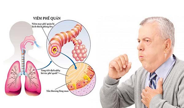 Lúa mạch là một trong những loại ngũ cốc được tiêu thụ rộng rãi nhất trong chế độ ăn uống của người Mỹ có thể thay bữa ăn sáng mà vẫn đầy chất dinh dưỡng và tốt cho sức khỏe. Loại hạt đa năng này có vị hơi chát và hương vị hạt dẻ có thể bổ sung vào nhiều món ăn. Đồng thời được cho là cung cấp nhiều lợi ích sức khỏe cho cơ thể con người trong xã hội hiện đại ngày nay. Lúa mạch là một trong những loại ngũ cốc được tiêu thụ rộng rãi trên toàn thế giới, tuy nhiên khá xa lạ ở Việt Nam. Có rất nhiều loại ngũ cốc được mọi người ưa chuộng vì độ dinh dưỡng và hương vị thơm ngon, trong đó phải kể đến lúa mạch. Vậy lúa mạch là gì? Lúa mạch có tác dụng gì? Vậy hãy cùng An Thành tìm hiểu chúng qua bài viết dưới đây nhé! Có bao nhiêu loại lúa mạch khác nhau? Lúa mạch đen hay hắc mạch thuộc chi Secale (bao gồm cả loài được gieo trồng có danh pháp Secale cereale). Đại mạch thuộc chi Hordeum (bao gồm cả loài được gieo trồng có danh pháp Hordeum vulgare) Triticum là lúa mì hay tiểu mạch. Yến mạch, thuộc chi Avena Tiểu hắc mạch (lai ghép giữa lúa mì và hắc mạch) hay × Triticosecale. Lúa mạch là gì? - Lúa mạch tiếng anh là barley, có tên khoa học là Hordeum vulgare L thuộc họ Lúa. Lúa mạch thuộc dạng cây thảo, rễ lúa dạng sợi. Thân cây lúa mạch to, mọc đứng cao 50 – 100 cm. Lá phẳng, ráp, lưỡi bẹ ngắn. Bông lúa mạch nhỏ, đều sinh sản xếp trên 4 dãy. - Theo nhiều nghiên cứu cho thấy lúa mạch chứa nhiều vitamin nhóm B, sắt và chất xơ có tác dụng cực tốt đối với sức khỏe. Sử dụng lúa mạch mỗi ngày giúp cơ thể khỏe mạnh hơn. Chính vì vậy lúa mạch được trồng để lấy hạt lúa mạch ăn và làm bánh mì lúa mạch, bánh quy lúa mạch, mầm được dùng để làm kẹo lúa mạch, chế rượu bia, làm mạch nha. Lúa mạch có tác dụng gì? Giúp cân bằng vi khuẩn đường ruột Một trong những cách tốt nhất để cân bằng vi khuẩn đường ruột là bổ sung các thực phẩm được làm từ lúa mạch. Nhiều cuộc nghiên cứu chỉ ra rằng: lúa mạch chứa nhiều hợp chất có lợi, giúp tăng sinh lợi khuẩn và tiêu diệt các hại khuẩn trong đường ruột. Từ đó, giúp cơ thể khoẻ mạnh hơn và ngăn ngừa nguy cơ nhiễm trùng hiệu quả. Tăng cường chất xơ: Lúa mạch là một nguồn cung cấp chất xơ dồi dào cho cơ thể chúng ta. Chất xơ không những giúp cung cấp năng lượng mà còn thúc đẩy quá trình nhu động ruột, giúp hệ tiêu hoá khoẻ mạnh hơn và phòng ngừa chứng táo bón, đầy hơi hiệu quả. Hơn nữa, theo nghiên cứu của các nhà khoa học: chế độ ăn giàu chất xơ còn giúp giảm thiểu nguy cơ mắc các bệnh mãn tính. Trong đó có bệnh tim. Giàu chất dinh dưỡng có lợi: Giống như các loại ngũ cốc nguyên hạt khác, lúa mạch cũng chứa nhiều thành phần dinh dưỡng thiết yếu như: chất xơ, protein, vitamin B1, B3 cùng các loại khoáng chất phong phú như đồng, magie, photpho,... Ngoài ra, trong yến mạch còn chứa lignans - một hợp chất chống oxy hoá có tác dụng ngăn ngừa bệnh tật, giảm thiểu nguy cơ mắc bệnh tim và ung thư. Tuy nhiên, thực phẩm này cũng có chứa chất kháng dinh dưỡng. Vì thế, bạn nên ngâm hạt kỹ trước khi chế biến để loại bỏ bớt, giúp cơ thể dễ dàng tiêu hoá và hấp thụ dinh dưỡng tốt hơn. Lúa mạch hỗ trợ giảm cân hiệu quả: Trong yến mạch có chứa một lượng lớn chất xơ hòa tan beta-glucan. Khi tiêu thụ vào cơ thể sẽ tạo ra một chất giống như gel trong đường ruột, giúp làm chậm quá trình rỗng dạ dày. Từ đó, khiến bạn có cảm giác no lâu hơn, kiểm soát cơn thèm ăn và giảm cân hiệu quả. Một đánh giá dựa trên 44 cuộc nghiên cứu cho thấy: chế độ ăn giàu chất xơ hoà tan hoàn toàn có khả năng kiểm soát cảm giác thèm ăn và hỗ trợ quá trình giảm cân. Hơn nữa, nghiên cứu trên 1 nhóm người có mỡ bụng cho thấy: thực hiện chế độ ăn giàu chất xơ hoà tan giúp họ cải thiện vòng eo rõ rệt. Hỗ trợ ngăn ngừa sỏi mật: Sỏi mật là những hạt dạng rắn hình thành trong túi mật do nồng độ cholesterol dư thừa quá cao, gây ra triệu chứng đau lưng, buồn nôn, vàng da, sốt và nguy hiểm hơn là các cơn đau dữ dội cần phải thực hiện phẫu thuật cắt bỏ túi mật. Chất xơ không hoà tan trong lúa mạch có tác dụng ngăn ngừa sự hình thành và phát triển của sỏi mật. Một nghiên cứu quan sát ở những người phụ nữ kéo dài 16 năm cho thấy: chế độ ăn giàu chất xơ giúp giảm nguy cơ sỏi mật đến 13%. Ngoài ra, 1 cuộc nghiên cứu khác thực hiện ở những người béo phì trong 5 tuần cũng chứng minh rằng: nhóm bổ sung nhiều chất xơ có túi mật khoẻ mạnh hơn gấp 3 lần so với nhóm đối chứng. Lưu ý: Giảm cân nhanh chóng có thể làm tăng nguy cơ phát triển sỏi mật. - Trong một nghiên cứu, những người béo phì được thực hiện một trong hai chế độ ăn kiêng giảm cân nhanh chóng. Trong đó bao gồm một chế độ ăn giàu chất xơ, chế độ ăn còn lại giàu protein. Sau 5 tuần, những người tham gia chế độ ăn giàu chất xơ có khả năng có túi mật khỏe mạnh hơn gấp 3 lần so với những người theo chế độ ăn giàu protein. Vì vậy, khi thực hiện chế độ ăn kiêng giảm cân nhanh chóng, bạn nên ưu tiên chế độ ăn giàu chất xơ hơn. Giúp giảm cholesterol: Beta-glucan trong lúa mạch có tác dụng làm giảm cholesterol xấu LDL bằng cách gắn kết với các axit mật rồi đào thải qua đường tiêu hoá. Từ đó, cân bằng lượng cholesterol lưu thông trong máu của bạn. Nghiên cứu thực hiện trên 1 nhóm người có lượng cholesterol cao trong 5 tuần cho thấy: Chế độ ăn giàu lúa mạch giúp làm giảm lượng chất béo trung tính, cholesterol nhiều hơn so với chế độ ăn giàu gạo lứt và lúa mì. Ngoài ra, lúa mạch còn làm tăng lượng cholesterol tốt HDL đáng kể. Hạn chế các nguy cơ về tim mạch: Chất xơ hoà tan trong lúa mạch có khả năng làm giảm cholesterol xấu LDL. Từ đó, cân bằng huyết áp và ngăn ngừa nguy cơ mắc các bệnh về tim mạch hiệu quả. Một đánh giá về các cuộc nghiên cứu ngẫu nhiên cho thấy rằng: bổ sung 8.7gr chất xơ hoà tan mỗi ngày giúp làm giảm huyết áp cao từ 0.3 - 1.6mmHg. Điều này rất có lợi trong việc bảo vệ sức khoẻ tim mạch. Hỗ trợ chống lại bệnh tiểu đường: - Lúa mạch rất giàu magie và chất xơ hoà tan. Cả 2 hợp chất này đều có tác dụng hữu ích trong việc ngăn ngừa nguy cơ mắc bệnh tiểu đường. Cụ thể: Magie giúp cải thiện độ nhạy insulin, hỗ trợ quá trình chuyển hoá glucose. Từ đó, làm giảm lượng đường trong máu. Chất xơ hoà tan khi di chuyển qua đường tiêu hoá sẽ liên kết với nước và các phân tử khác để làm chậm quá trình hấp thụ đường vào máu. Từ đó, ngăn ngừa đường huyết tăng đột ngột gây ra bệnh tiểu đường. - Một nghiên cứu thực hiện ở những người bị rối loạn đường huyết trong 3 tháng cho thấy: nhóm ăn bột lúa mạch hằng ngày có lượng đường trong máu lúc đói và mức insulin thấp hơn 13% so với nhóm ăn yến mạch. Giảm ung thư ruột kết: Lúa mạch có chứa 2 loại chất xơ hoà tan và không hoà tan, giúp ngăn ngừa nguy cơ mắc bệnh ung thư ruột kết. Trong đó: Chất xơ hoà tan có khả năng chống lại bệnh ung thư ruột kết bằng cách bám chặt vào các chất gây ung thư, rồi loại bỏ chúng qua đường tiêu hoá. Chất xơ không hoà tan giúp cân bằng pH trong đường ruột, làm giảm chứng táo bón và ngăn ngừa ung thư ruột già. Ngoài ra, lúa mạch còn một số chất chống oxy hoá mạnh mẽ như: axit phytic, phenolic và saponin giúp trung hoà gốc tự do, chống lại các tế bào ung thư. Bao gồm cả ung thư ruột kết. Giúp phòng chống loãng xương: Lúa mạch là một nguồn cung cấp canxi, photpho và đồng tuyệt vời cho cơ thể chúng ta. Đây là những khoáng chất thiết yếu cho quá trình xây dựng và duy trì cấu trúc xương. Từ đó, ngăn ngừa nguy cơ loãng xương hiệu quả. Tốt cho người thiếu máu: Thiếu máu gây ra triệu chứng: chóng mặt, đau đầu, ù tai, chán ăn, mệt mỏi,...làm ảnh hưởng đến cuộc sống và công việc. Thật may khi lúa mạch có thể giúp bạn giải quyết vấn đề này. Tiêu thụ hàm lượng sắt và đồng có trong lúa mạch giúp thúc đẩy quá trình sản xuất tế bào hồng cầu và hemoglobin, điều hoà lưu lượng máu. Từ đó, ngăn ngừa bệnh thiếu máu hiệu quả. Hỗ trợ trong việc chăm sóc da: Lúa mạch rất giàu selen, có tác dụng chống lại các tế bào gây hại của gốc tự do và tình trạng oxy hóa làn da. Từ đó, ngăn ngừa các nếp nhăn, sạm da và duy trì độ đàn hồi, giúp da sáng khoẻ, mịn màng. Giảm tình trạng hen suyễn: Nghiên cứu được công bố trên tạp chí Plant Molecular Biology cho thấy: protein nội nhũ 14.5 kDa trong lúa mạch có khả năng làm giảm các triệu chứng hen suyễn thường gặp ở thợ làm bánh hiệu quả. Phân biệt lúa mạch và lúa mì, yến mạch, lúa mạch đen: Tiêu chí phân biệtLúa mì Lúa mạch Yến mạch Lúa mạch đen Mùa vụ Hằng năm Hằng năm hoặc hai năm một lần Hằng năm Hằng năm hoặc hai năm một lần Chiều cao thân 45 - 150cm 60 - 80cm 50 - 170cm 80 - 100cm Đặc điểm thân cây Thân cây thẳng, bên trong ruột rỗng Thân cây thẳng, mỏng như cọng rơm Thân mỏng, đường kính khoảng 3 - 6mm Có 2 - 3 khía Thân mọc đối dưới chùm hoa Bên trong rỗng, bên ngoài bóng, gồm 5 - 6 lóng Đặc điểm hạt Hình bầu dục hoặc hình trứng Có 1 đường rãnh ở giữa Hình trái xoan Có đường rãnh dọc Nhìn giống hạt gạo Bên ngoài có 1 lớp vỏ cứng Dáng thuôn dài, nén theo chiều ngang Có đường rãnh sâu ở giữa Cách sử dụng lúa mạch: Với lúa mạch, bạn có thể thể chế biến thành một số món ăn thơm ngon và bổ dưỡng như: Nấu cùng với nước hoặc sữa tươi không đường để làm cháo lúa mạch. Trộn cùng với món súp, món hầm để tăng thêm hương vị. Kết hợp với bột mì để làm món bánh mì lúa mạch. Trộn cùng rau xanh, nước sốt để làm món salad. Chế biến 1 số loại thức uống thơm ngon như: trà lúa mạch, sinh tố lúa mạch, sữa lúa mạch,... Những điểm cần lưu ý khi sử dụng lúa mạch: - Lúa mạch có chứa gluten. Do vậy, không thích hợp cho những người bị bệnh celiac, dị ứng lúa mì hoặc không nhạy cảm với gluten. Mạch nha, đồ uống có mạch nha như bia, và một số hương liệu sử dụng lúa mạch làm cơ sở. Do đó, chúng cũng chứa gluten. - Điều quan trọng là những người muốn tăng lượng chất xơ nên thực hiện dần dần. Điều này là do đột ngột thêm nhiều chất xơ vào chế độ ăn uống có thể dẫn đến các vấn đề tiêu hóa tạm thời. Chẳng hạn như đầy hơi, khi cơ thể thích nghi với sự thay đổi. - Uống nhiều chất lỏng trong khi tăng lượng chất xơ có thể giúp ngăn ngừa táo bón. Lúa mạch là một loại ngũ cốc rất tốt cho sức khỏe. Lúa mạch giàu vitamin, chất xơ, khoáng chất và các hợp chất thực vật có lợi khác. Hơn nữa, lúa mạch có thể bảo vệ bạn khỏi các bệnh mãn tính. Chẳng hạn như bệnh tiểu đường, bệnh tim và thậm chí một số loại ung thư. Một số câu hỏi liên quan đến lúa mạch ta cần biết: ** Lúa mạch và yến mạch có phải là một? - Thực chất, lúa mạch và yến mạch là hai loại ngũ cốc khác nhau và được sử dụng để chế biến thành các sản phẩm khác nhau. Công dụng chính của lúa mạch là sử dụng để làm thành bia. Ngoài ra còn được xay thành bột mịn, sau đó sử dụng  làm bánh và các loại mì được làm bằng tay, hoặc rắc lên trên ngũ cốc, sữa chua. - Đối với yến mạch là loại ngũ cốc lấy hạt và được cán dẹp. Với loại thực phẩm này thường dùng để chế biến món ăn như cháo yến mạch, bột yến mạch. Hơn nữ, yến mạch còn được sử dụng để đắp mặt nạ, dưỡng da. ** Ăn lúa mạch có mập không? - Với những người có mong muốn giảm cân thì cách tốt nhất là sử dụng ngũ cốc lúa mạch cho mỗi ngày. Trong thành phần của lúa mạch có hàm lượng calo rất thấp, nếu kết hợp cùng nước hoặc sữa tươi không đường khi làm ngũ cốc ăn sẽ giúp bạn giảm cân nhanh chóng. Khi ăn ngũ cốc từ lúa mạch thành phần carbohydrate sẽ giúp hệ tiêu hóa hấp thu từ từ, tạo cảm giác no lâu hơn; bên cạnh đó lượng chất xơ lớn trong lúa mạch giúp loại bỏ độc tố và chất béo từ thực phẩm. ** Lúa mạch có thể làm ra món gì? - Lúa mạch ngoài là nguyên liệu làm ra bia, nó còn được áp dụng trong khá nhiều loại bánh, ngũ cốc, súp,… Bản chất của loại lúa mạch này có mùi thơm nhẹ, do đó các bà mẹ có thể chế biến thành món ăn kết hợp với nhiều nguyên liệu khác để làm bánh, nấu cháo cho bé. CÔNG TY TNHH SẢN XUẤT – THƯƠNG MẠI – DỊCH VỤ – AN THÀNH Địa chỉ: 47/80 Ao Đôi, Khu Phố 10, Phường Bình Trị Đông A, Quận Bình Tân, TP.HCM Email: anthanhsale01@gmail.com Hotline (zalo) :  0903103922 – 0906312325 Website: https://www.packvn.com/ – https://maydonggoi.vip/ Facebook: https://www.facebook.com/maydonggoianthanh Pinterest: https://www.pinterest.com/donggoianthanh/_saved/ Instagram: https://www.instagram.com/maydonggoianthanh/ Twitter:https://twitter.com/donggoianthanh Linkedin: https://www.linkedin.com/in/may-dong-goi-bao-bi-an-thanh/ Youtube: Máy đóng gói An Thành – YouTube.