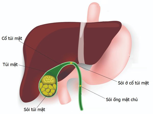 Lúa mạch là một trong những loại ngũ cốc được tiêu thụ rộng rãi nhất trong chế độ ăn uống của người Mỹ có thể thay bữa ăn sáng mà vẫn đầy chất dinh dưỡng và tốt cho sức khỏe. Loại hạt đa năng này có vị hơi chát và hương vị hạt dẻ có thể bổ sung vào nhiều món ăn. Đồng thời được cho là cung cấp nhiều lợi ích sức khỏe cho cơ thể con người trong xã hội hiện đại ngày nay. Lúa mạch là một trong những loại ngũ cốc được tiêu thụ rộng rãi trên toàn thế giới, tuy nhiên khá xa lạ ở Việt Nam. Có rất nhiều loại ngũ cốc được mọi người ưa chuộng vì độ dinh dưỡng và hương vị thơm ngon, trong đó phải kể đến lúa mạch. Vậy lúa mạch là gì? Lúa mạch có tác dụng gì? Vậy hãy cùng An Thành tìm hiểu chúng qua bài viết dưới đây nhé! Có bao nhiêu loại lúa mạch khác nhau? Lúa mạch đen hay hắc mạch thuộc chi Secale (bao gồm cả loài được gieo trồng có danh pháp Secale cereale). Đại mạch thuộc chi Hordeum (bao gồm cả loài được gieo trồng có danh pháp Hordeum vulgare) Triticum là lúa mì hay tiểu mạch. Yến mạch, thuộc chi Avena Tiểu hắc mạch (lai ghép giữa lúa mì và hắc mạch) hay × Triticosecale. Lúa mạch là gì? - Lúa mạch tiếng anh là barley, có tên khoa học là Hordeum vulgare L thuộc họ Lúa. Lúa mạch thuộc dạng cây thảo, rễ lúa dạng sợi. Thân cây lúa mạch to, mọc đứng cao 50 – 100 cm. Lá phẳng, ráp, lưỡi bẹ ngắn. Bông lúa mạch nhỏ, đều sinh sản xếp trên 4 dãy. - Theo nhiều nghiên cứu cho thấy lúa mạch chứa nhiều vitamin nhóm B, sắt và chất xơ có tác dụng cực tốt đối với sức khỏe. Sử dụng lúa mạch mỗi ngày giúp cơ thể khỏe mạnh hơn. Chính vì vậy lúa mạch được trồng để lấy hạt lúa mạch ăn và làm bánh mì lúa mạch, bánh quy lúa mạch, mầm được dùng để làm kẹo lúa mạch, chế rượu bia, làm mạch nha. Lúa mạch có tác dụng gì? Giúp cân bằng vi khuẩn đường ruột Một trong những cách tốt nhất để cân bằng vi khuẩn đường ruột là bổ sung các thực phẩm được làm từ lúa mạch. Nhiều cuộc nghiên cứu chỉ ra rằng: lúa mạch chứa nhiều hợp chất có lợi, giúp tăng sinh lợi khuẩn và tiêu diệt các hại khuẩn trong đường ruột. Từ đó, giúp cơ thể khoẻ mạnh hơn và ngăn ngừa nguy cơ nhiễm trùng hiệu quả. Tăng cường chất xơ: Lúa mạch là một nguồn cung cấp chất xơ dồi dào cho cơ thể chúng ta. Chất xơ không những giúp cung cấp năng lượng mà còn thúc đẩy quá trình nhu động ruột, giúp hệ tiêu hoá khoẻ mạnh hơn và phòng ngừa chứng táo bón, đầy hơi hiệu quả. Hơn nữa, theo nghiên cứu của các nhà khoa học: chế độ ăn giàu chất xơ còn giúp giảm thiểu nguy cơ mắc các bệnh mãn tính. Trong đó có bệnh tim. Giàu chất dinh dưỡng có lợi: Giống như các loại ngũ cốc nguyên hạt khác, lúa mạch cũng chứa nhiều thành phần dinh dưỡng thiết yếu như: chất xơ, protein, vitamin B1, B3 cùng các loại khoáng chất phong phú như đồng, magie, photpho,... Ngoài ra, trong yến mạch còn chứa lignans - một hợp chất chống oxy hoá có tác dụng ngăn ngừa bệnh tật, giảm thiểu nguy cơ mắc bệnh tim và ung thư. Tuy nhiên, thực phẩm này cũng có chứa chất kháng dinh dưỡng. Vì thế, bạn nên ngâm hạt kỹ trước khi chế biến để loại bỏ bớt, giúp cơ thể dễ dàng tiêu hoá và hấp thụ dinh dưỡng tốt hơn. Lúa mạch hỗ trợ giảm cân hiệu quả: Trong yến mạch có chứa một lượng lớn chất xơ hòa tan beta-glucan. Khi tiêu thụ vào cơ thể sẽ tạo ra một chất giống như gel trong đường ruột, giúp làm chậm quá trình rỗng dạ dày. Từ đó, khiến bạn có cảm giác no lâu hơn, kiểm soát cơn thèm ăn và giảm cân hiệu quả. Một đánh giá dựa trên 44 cuộc nghiên cứu cho thấy: chế độ ăn giàu chất xơ hoà tan hoàn toàn có khả năng kiểm soát cảm giác thèm ăn và hỗ trợ quá trình giảm cân. Hơn nữa, nghiên cứu trên 1 nhóm người có mỡ bụng cho thấy: thực hiện chế độ ăn giàu chất xơ hoà tan giúp họ cải thiện vòng eo rõ rệt. Hỗ trợ ngăn ngừa sỏi mật: Sỏi mật là những hạt dạng rắn hình thành trong túi mật do nồng độ cholesterol dư thừa quá cao, gây ra triệu chứng đau lưng, buồn nôn, vàng da, sốt và nguy hiểm hơn là các cơn đau dữ dội cần phải thực hiện phẫu thuật cắt bỏ túi mật. Chất xơ không hoà tan trong lúa mạch có tác dụng ngăn ngừa sự hình thành và phát triển của sỏi mật. Một nghiên cứu quan sát ở những người phụ nữ kéo dài 16 năm cho thấy: chế độ ăn giàu chất xơ giúp giảm nguy cơ sỏi mật đến 13%. Ngoài ra, 1 cuộc nghiên cứu khác thực hiện ở những người béo phì trong 5 tuần cũng chứng minh rằng: nhóm bổ sung nhiều chất xơ có túi mật khoẻ mạnh hơn gấp 3 lần so với nhóm đối chứng. Lưu ý: Giảm cân nhanh chóng có thể làm tăng nguy cơ phát triển sỏi mật. - Trong một nghiên cứu, những người béo phì được thực hiện một trong hai chế độ ăn kiêng giảm cân nhanh chóng. Trong đó bao gồm một chế độ ăn giàu chất xơ, chế độ ăn còn lại giàu protein. Sau 5 tuần, những người tham gia chế độ ăn giàu chất xơ có khả năng có túi mật khỏe mạnh hơn gấp 3 lần so với những người theo chế độ ăn giàu protein. Vì vậy, khi thực hiện chế độ ăn kiêng giảm cân nhanh chóng, bạn nên ưu tiên chế độ ăn giàu chất xơ hơn. Giúp giảm cholesterol: Beta-glucan trong lúa mạch có tác dụng làm giảm cholesterol xấu LDL bằng cách gắn kết với các axit mật rồi đào thải qua đường tiêu hoá. Từ đó, cân bằng lượng cholesterol lưu thông trong máu của bạn. Nghiên cứu thực hiện trên 1 nhóm người có lượng cholesterol cao trong 5 tuần cho thấy: Chế độ ăn giàu lúa mạch giúp làm giảm lượng chất béo trung tính, cholesterol nhiều hơn so với chế độ ăn giàu gạo lứt và lúa mì. Ngoài ra, lúa mạch còn làm tăng lượng cholesterol tốt HDL đáng kể. Hạn chế các nguy cơ về tim mạch: Chất xơ hoà tan trong lúa mạch có khả năng làm giảm cholesterol xấu LDL. Từ đó, cân bằng huyết áp và ngăn ngừa nguy cơ mắc các bệnh về tim mạch hiệu quả. Một đánh giá về các cuộc nghiên cứu ngẫu nhiên cho thấy rằng: bổ sung 8.7gr chất xơ hoà tan mỗi ngày giúp làm giảm huyết áp cao từ 0.3 - 1.6mmHg. Điều này rất có lợi trong việc bảo vệ sức khoẻ tim mạch. Hỗ trợ chống lại bệnh tiểu đường: - Lúa mạch rất giàu magie và chất xơ hoà tan. Cả 2 hợp chất này đều có tác dụng hữu ích trong việc ngăn ngừa nguy cơ mắc bệnh tiểu đường. Cụ thể: Magie giúp cải thiện độ nhạy insulin, hỗ trợ quá trình chuyển hoá glucose. Từ đó, làm giảm lượng đường trong máu. Chất xơ hoà tan khi di chuyển qua đường tiêu hoá sẽ liên kết với nước và các phân tử khác để làm chậm quá trình hấp thụ đường vào máu. Từ đó, ngăn ngừa đường huyết tăng đột ngột gây ra bệnh tiểu đường. - Một nghiên cứu thực hiện ở những người bị rối loạn đường huyết trong 3 tháng cho thấy: nhóm ăn bột lúa mạch hằng ngày có lượng đường trong máu lúc đói và mức insulin thấp hơn 13% so với nhóm ăn yến mạch. Giảm ung thư ruột kết: Lúa mạch có chứa 2 loại chất xơ hoà tan và không hoà tan, giúp ngăn ngừa nguy cơ mắc bệnh ung thư ruột kết. Trong đó: Chất xơ hoà tan có khả năng chống lại bệnh ung thư ruột kết bằng cách bám chặt vào các chất gây ung thư, rồi loại bỏ chúng qua đường tiêu hoá. Chất xơ không hoà tan giúp cân bằng pH trong đường ruột, làm giảm chứng táo bón và ngăn ngừa ung thư ruột già. Ngoài ra, lúa mạch còn một số chất chống oxy hoá mạnh mẽ như: axit phytic, phenolic và saponin giúp trung hoà gốc tự do, chống lại các tế bào ung thư. Bao gồm cả ung thư ruột kết. Giúp phòng chống loãng xương: Lúa mạch là một nguồn cung cấp canxi, photpho và đồng tuyệt vời cho cơ thể chúng ta. Đây là những khoáng chất thiết yếu cho quá trình xây dựng và duy trì cấu trúc xương. Từ đó, ngăn ngừa nguy cơ loãng xương hiệu quả. Tốt cho người thiếu máu: Thiếu máu gây ra triệu chứng: chóng mặt, đau đầu, ù tai, chán ăn, mệt mỏi,...làm ảnh hưởng đến cuộc sống và công việc. Thật may khi lúa mạch có thể giúp bạn giải quyết vấn đề này. Tiêu thụ hàm lượng sắt và đồng có trong lúa mạch giúp thúc đẩy quá trình sản xuất tế bào hồng cầu và hemoglobin, điều hoà lưu lượng máu. Từ đó, ngăn ngừa bệnh thiếu máu hiệu quả. Hỗ trợ trong việc chăm sóc da: Lúa mạch rất giàu selen, có tác dụng chống lại các tế bào gây hại của gốc tự do và tình trạng oxy hóa làn da. Từ đó, ngăn ngừa các nếp nhăn, sạm da và duy trì độ đàn hồi, giúp da sáng khoẻ, mịn màng. Giảm tình trạng hen suyễn: Nghiên cứu được công bố trên tạp chí Plant Molecular Biology cho thấy: protein nội nhũ 14.5 kDa trong lúa mạch có khả năng làm giảm các triệu chứng hen suyễn thường gặp ở thợ làm bánh hiệu quả. Phân biệt lúa mạch và lúa mì, yến mạch, lúa mạch đen: Tiêu chí phân biệtLúa mì Lúa mạch Yến mạch Lúa mạch đen Mùa vụ Hằng năm Hằng năm hoặc hai năm một lần Hằng năm Hằng năm hoặc hai năm một lần Chiều cao thân 45 - 150cm 60 - 80cm 50 - 170cm 80 - 100cm Đặc điểm thân cây Thân cây thẳng, bên trong ruột rỗng Thân cây thẳng, mỏng như cọng rơm Thân mỏng, đường kính khoảng 3 - 6mm Có 2 - 3 khía Thân mọc đối dưới chùm hoa Bên trong rỗng, bên ngoài bóng, gồm 5 - 6 lóng Đặc điểm hạt Hình bầu dục hoặc hình trứng Có 1 đường rãnh ở giữa Hình trái xoan Có đường rãnh dọc Nhìn giống hạt gạo Bên ngoài có 1 lớp vỏ cứng Dáng thuôn dài, nén theo chiều ngang Có đường rãnh sâu ở giữa Cách sử dụng lúa mạch: Với lúa mạch, bạn có thể thể chế biến thành một số món ăn thơm ngon và bổ dưỡng như: Nấu cùng với nước hoặc sữa tươi không đường để làm cháo lúa mạch. Trộn cùng với món súp, món hầm để tăng thêm hương vị. Kết hợp với bột mì để làm món bánh mì lúa mạch. Trộn cùng rau xanh, nước sốt để làm món salad. Chế biến 1 số loại thức uống thơm ngon như: trà lúa mạch, sinh tố lúa mạch, sữa lúa mạch,... Những điểm cần lưu ý khi sử dụng lúa mạch: - Lúa mạch có chứa gluten. Do vậy, không thích hợp cho những người bị bệnh celiac, dị ứng lúa mì hoặc không nhạy cảm với gluten. Mạch nha, đồ uống có mạch nha như bia, và một số hương liệu sử dụng lúa mạch làm cơ sở. Do đó, chúng cũng chứa gluten. - Điều quan trọng là những người muốn tăng lượng chất xơ nên thực hiện dần dần. Điều này là do đột ngột thêm nhiều chất xơ vào chế độ ăn uống có thể dẫn đến các vấn đề tiêu hóa tạm thời. Chẳng hạn như đầy hơi, khi cơ thể thích nghi với sự thay đổi. - Uống nhiều chất lỏng trong khi tăng lượng chất xơ có thể giúp ngăn ngừa táo bón. Lúa mạch là một loại ngũ cốc rất tốt cho sức khỏe. Lúa mạch giàu vitamin, chất xơ, khoáng chất và các hợp chất thực vật có lợi khác. Hơn nữa, lúa mạch có thể bảo vệ bạn khỏi các bệnh mãn tính. Chẳng hạn như bệnh tiểu đường, bệnh tim và thậm chí một số loại ung thư. Một số câu hỏi liên quan đến lúa mạch ta cần biết: ** Lúa mạch và yến mạch có phải là một? - Thực chất, lúa mạch và yến mạch là hai loại ngũ cốc khác nhau và được sử dụng để chế biến thành các sản phẩm khác nhau. Công dụng chính của lúa mạch là sử dụng để làm thành bia. Ngoài ra còn được xay thành bột mịn, sau đó sử dụng  làm bánh và các loại mì được làm bằng tay, hoặc rắc lên trên ngũ cốc, sữa chua. - Đối với yến mạch là loại ngũ cốc lấy hạt và được cán dẹp. Với loại thực phẩm này thường dùng để chế biến món ăn như cháo yến mạch, bột yến mạch. Hơn nữ, yến mạch còn được sử dụng để đắp mặt nạ, dưỡng da. ** Ăn lúa mạch có mập không? - Với những người có mong muốn giảm cân thì cách tốt nhất là sử dụng ngũ cốc lúa mạch cho mỗi ngày. Trong thành phần của lúa mạch có hàm lượng calo rất thấp, nếu kết hợp cùng nước hoặc sữa tươi không đường khi làm ngũ cốc ăn sẽ giúp bạn giảm cân nhanh chóng. Khi ăn ngũ cốc từ lúa mạch thành phần carbohydrate sẽ giúp hệ tiêu hóa hấp thu từ từ, tạo cảm giác no lâu hơn; bên cạnh đó lượng chất xơ lớn trong lúa mạch giúp loại bỏ độc tố và chất béo từ thực phẩm. ** Lúa mạch có thể làm ra món gì? - Lúa mạch ngoài là nguyên liệu làm ra bia, nó còn được áp dụng trong khá nhiều loại bánh, ngũ cốc, súp,… Bản chất của loại lúa mạch này có mùi thơm nhẹ, do đó các bà mẹ có thể chế biến thành món ăn kết hợp với nhiều nguyên liệu khác để làm bánh, nấu cháo cho bé. CÔNG TY TNHH SẢN XUẤT – THƯƠNG MẠI – DỊCH VỤ – AN THÀNH Địa chỉ: 47/80 Ao Đôi, Khu Phố 10, Phường Bình Trị Đông A, Quận Bình Tân, TP.HCM Email: anthanhsale01@gmail.com Hotline (zalo) :  0903103922 – 0906312325 Website: https://www.packvn.com/ – https://maydonggoi.vip/ Facebook: https://www.facebook.com/maydonggoianthanh Pinterest: https://www.pinterest.com/donggoianthanh/_saved/ Instagram: https://www.instagram.com/maydonggoianthanh/ Twitter:https://twitter.com/donggoianthanh Linkedin: https://www.linkedin.com/in/may-dong-goi-bao-bi-an-thanh/ Youtube: Máy đóng gói An Thành – YouTube.