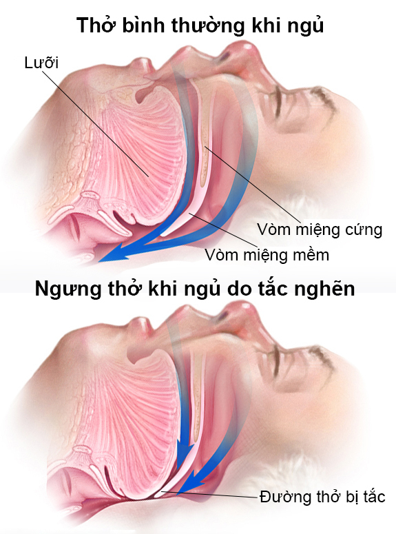 Rối loạn giấc ngủ được xem là những biểu hiện rất thường xảy ra trong y khoa nói chung và trong tâm thần học nói riêng. Chúng có thể gây trở ngại nghiêm trọng cho các hoạt động bình thường về thể chất, tinh thần, xã hội và ảnh hưởng lớn đến cảm xúc.